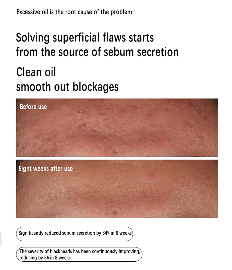 Niacinamide 10% + Zinc 1% Serum 30Ml Control Oil Remove Acne and Brighten Oily Skin Gentle Exfoliating Closed-Mouth Essence